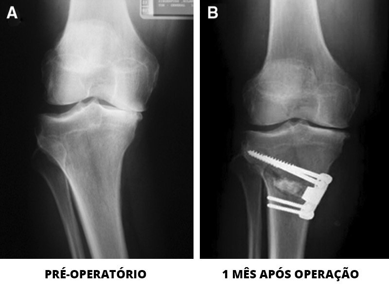 Osteotomia | Dr. Guilherme Losso