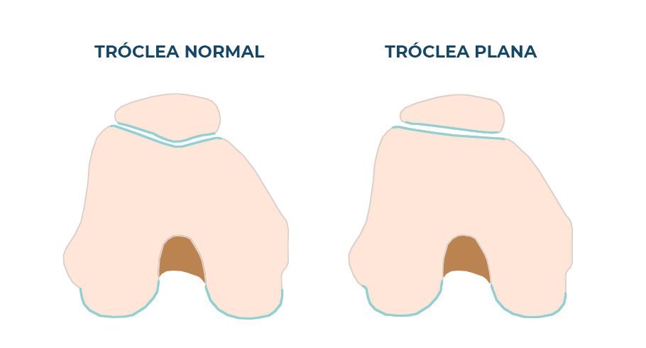 Displasia Troclear | Dr. Guilherme Losso