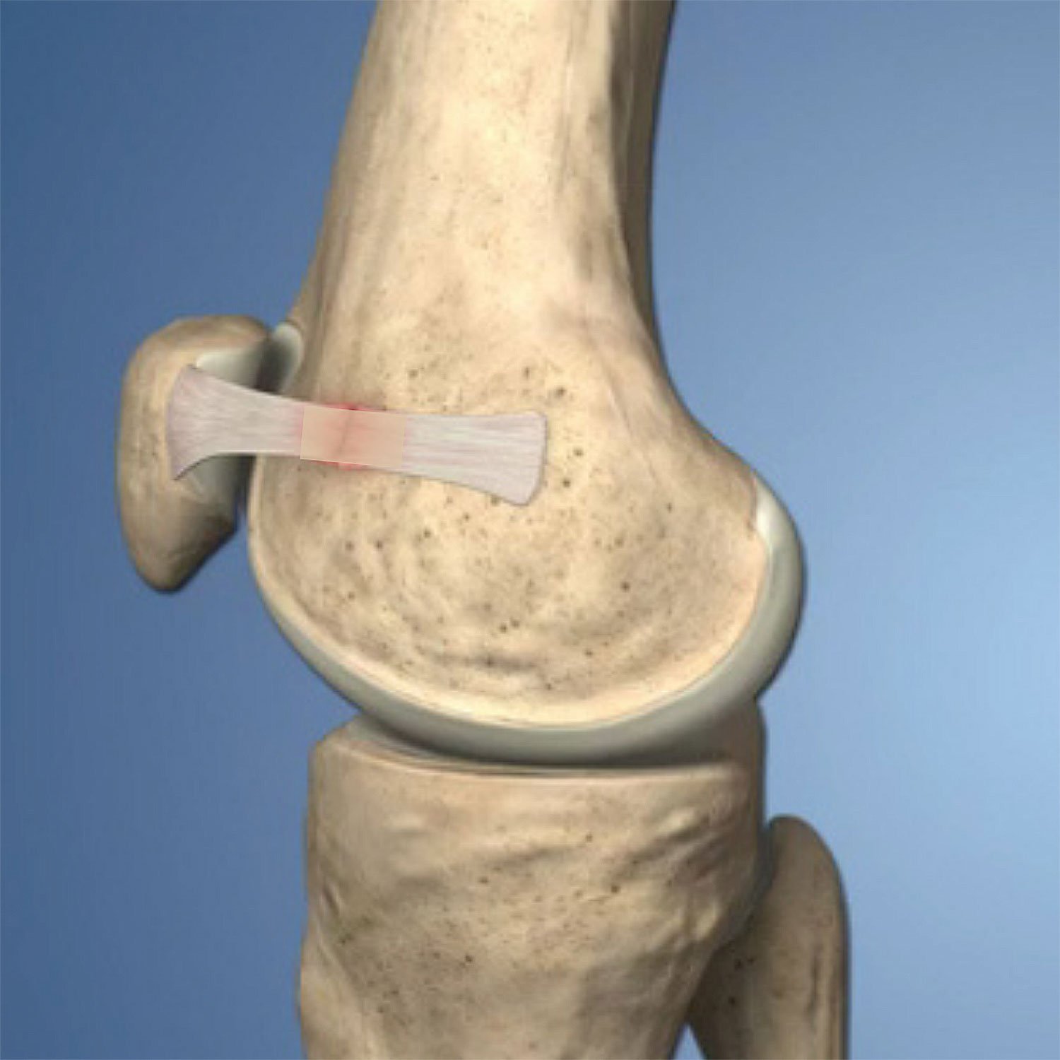 Lesão do ligamento patelofemoral medial | Dr Guilherme Losso