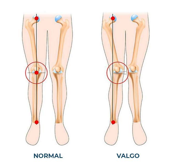 Joelho em Valgo | Dr. Guilherme Losso