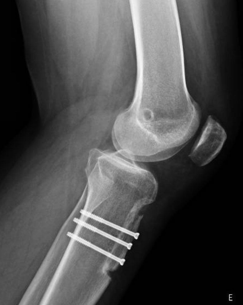 Osteotomia | Dr. Guilherme Losso