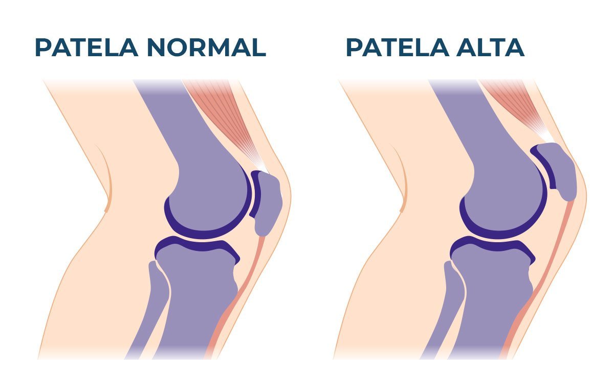 Patela Normal e Patela Alta | Dr. Guilherme Losso