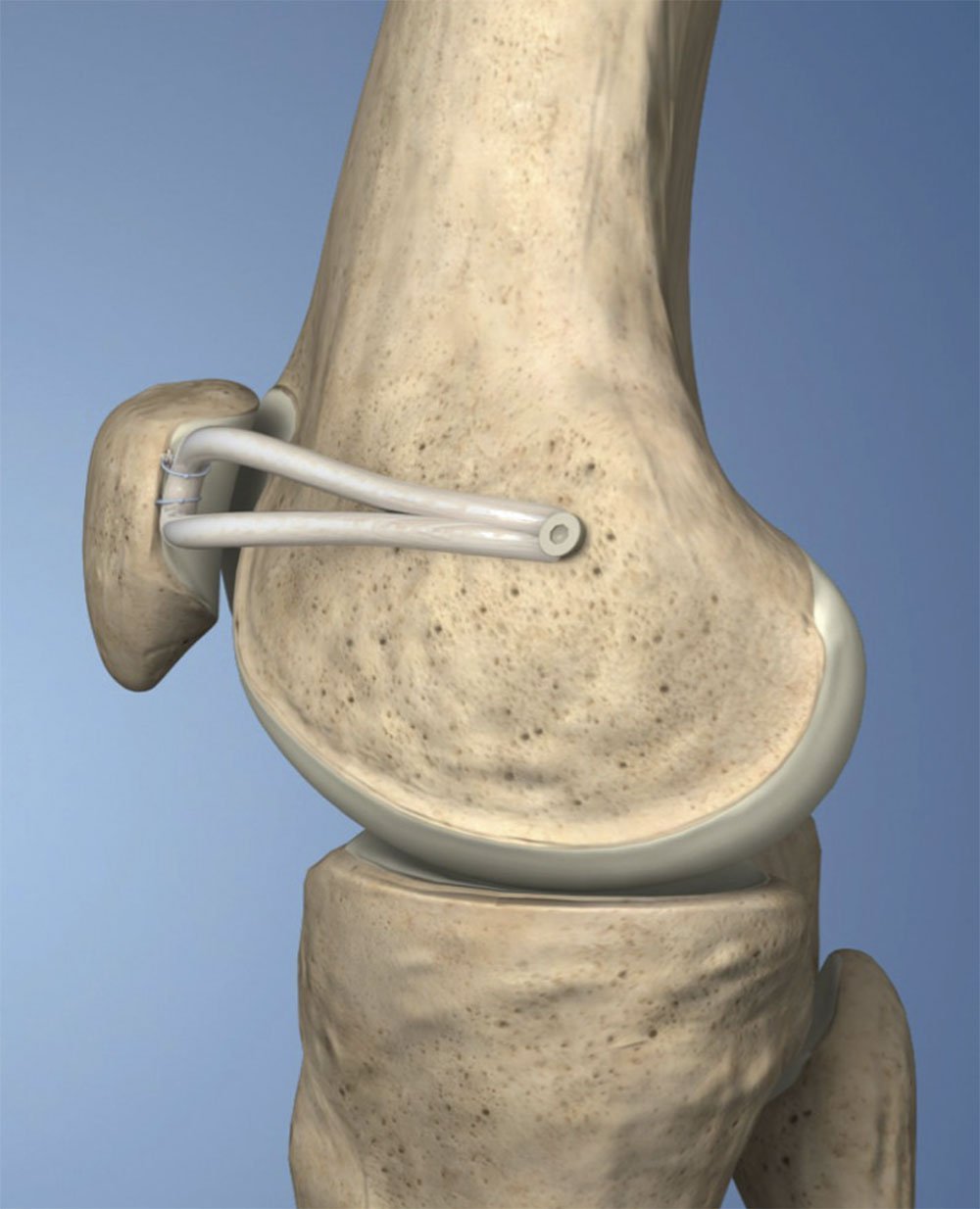 Reconstrução do ligamento patelofemoral medial | Dr. Guilherme Losso
