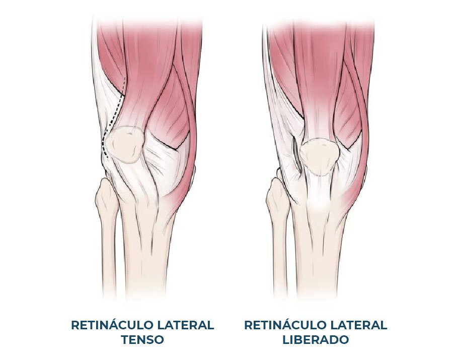 Release lateral | Dr. Guilherme Losso
